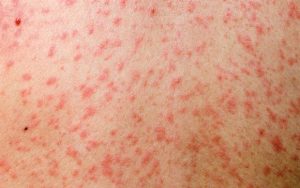 Measles-20160426092323637