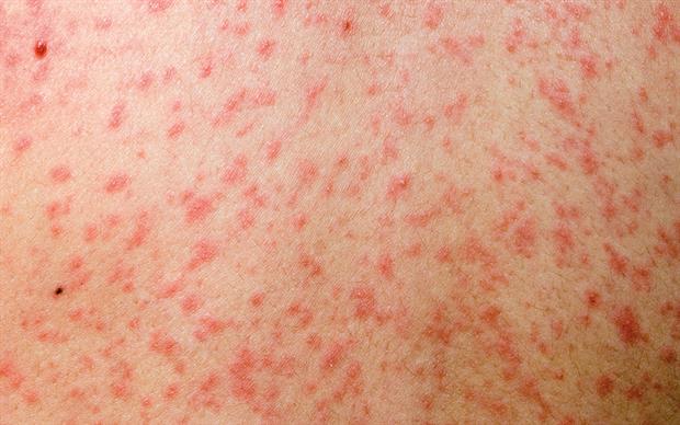 Measles-20160426092323637
