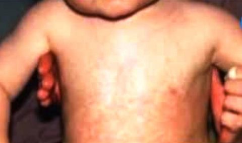 how-to-avoid-measles-this-summer-1280x720