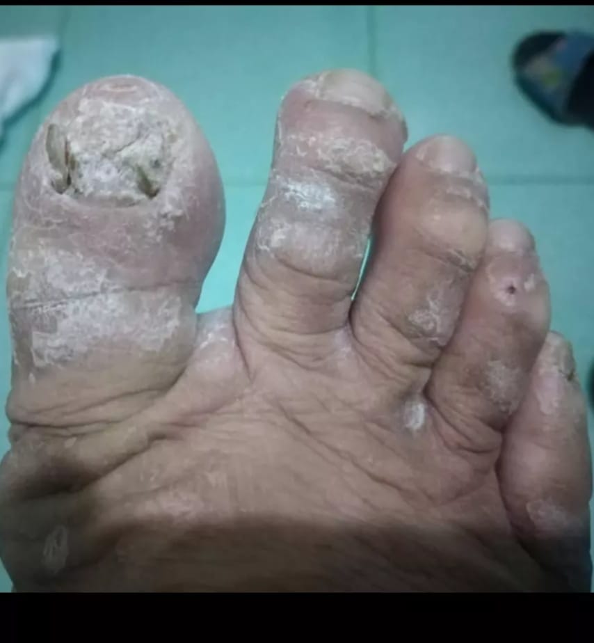 fungal