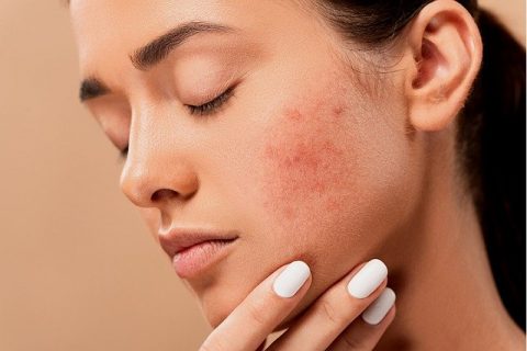 acne-5561750_640