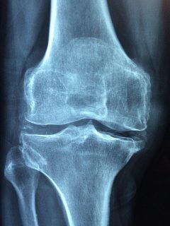 knee-1406964_640