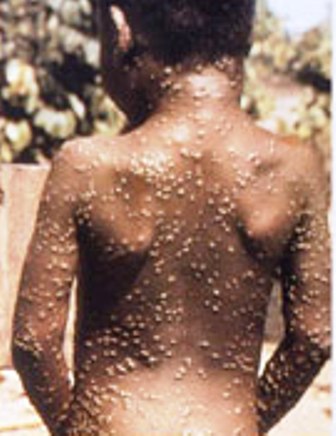 monkeypox-homepage-images-3 (1)